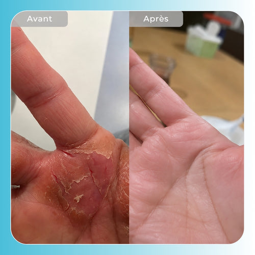 Vyren - Baume Réparateur Eczéma & Psoriasis