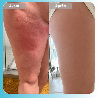 Vyren - Baume Réparateur Eczéma & Psoriasis