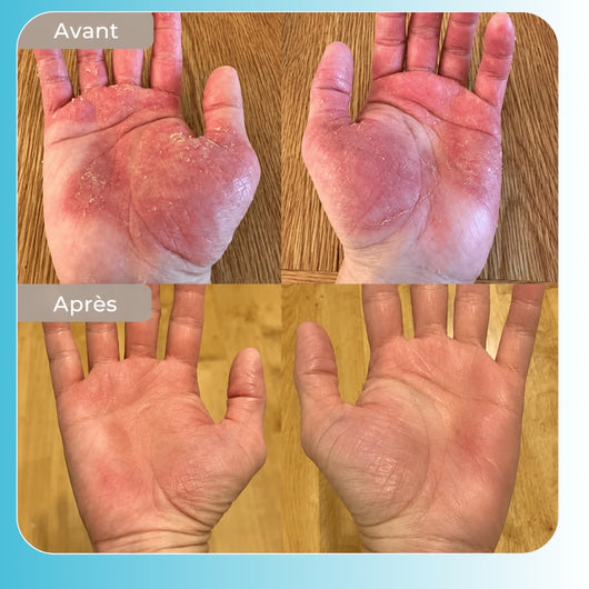 Vyren - Baume Réparateur Eczéma & Psoriasis